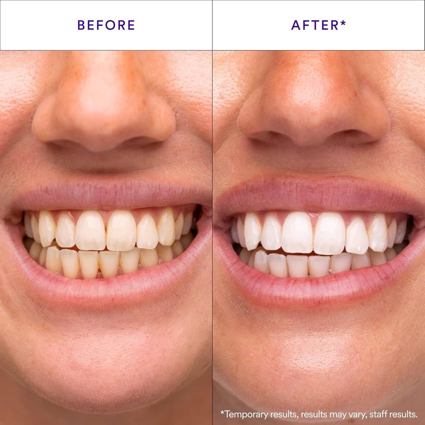 NOVA Purple Teeth Whitening Strips