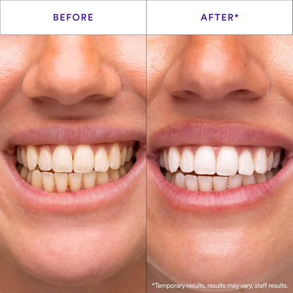 NOVA Purple Teeth Whitening Strips